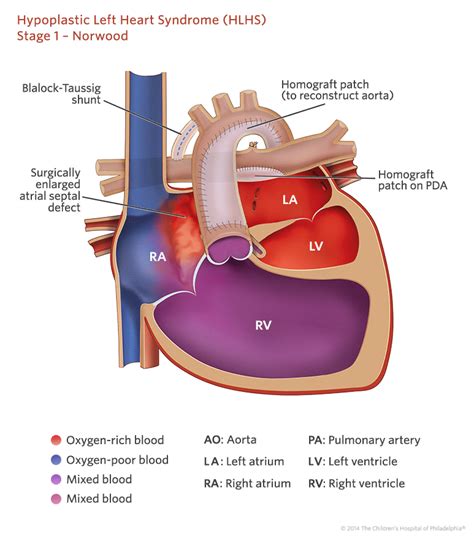 Staged Reconstruction Heart Surgery Childrens Hospital Of Philadelphia