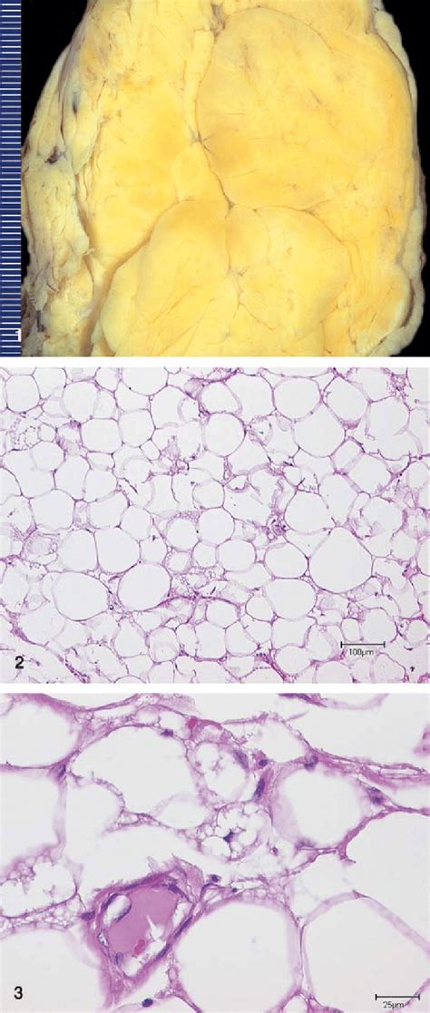 Atypical Lipomatous Tumor With Yellowish Cut Surface And Some Fibrous