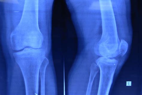 Figure Left Knee Tibial Eminence Fracture Statpearls Ncbi