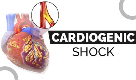 Cardiogenic Shock - The Wellness Corner