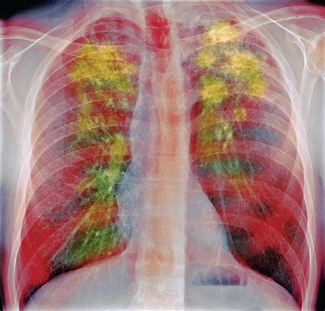 Endobronchial Ultrasound Guided Cryobiopsywhen It Is Indicated The