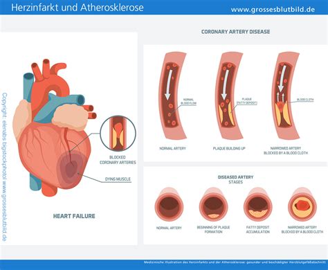 Cholesterin Blutwert Zu Hoch Ursachen Symptome Und Folgen