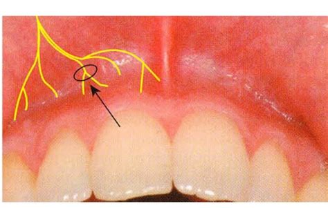 Maxillary Injection Technique PPT Flashcards Quizlet