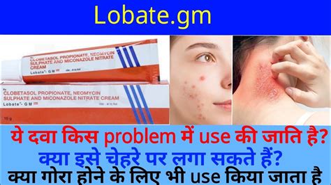 Lobate Gm Cream Use Dose Benefits Side Effects Full Review In Hindi