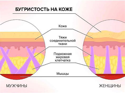 Виды целлюлита