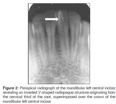 Mandibular Facial Talon Cusp: A Rare Case Report