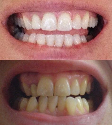 Braces Before And After Glow Up Teeth After Braces Braces Pain