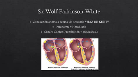 Sx Wolf Parkinson White Raymundo Saldaña Udocz