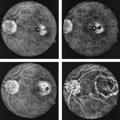 Limited Macular Translocation For The Management Of Subfoveal Choroidal