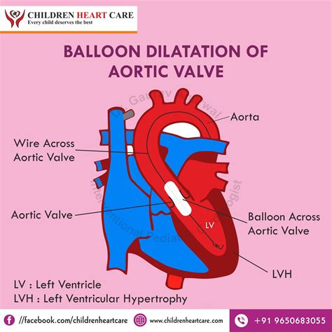 Aortic Stenosis Treatment in Delhi : Dr. Gaurav Agrawal