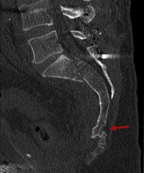 Coccydynia Diagnostic And Management Guidance The Journal For Nurse