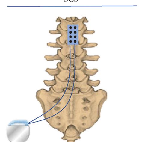 Neurostimulation Techniques For Chronic Pain Management Dbs Deep