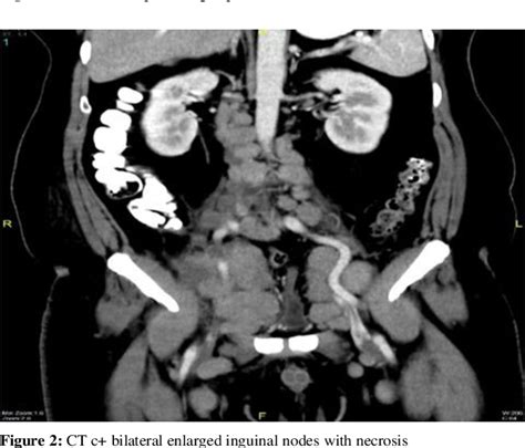 [pdf] Primary Testicular Lymphoma In Undescended Testis Of A Middle Age