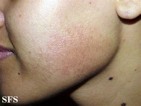 Erythromelanosis Follicularis Faciei Et Colli Wikidoc