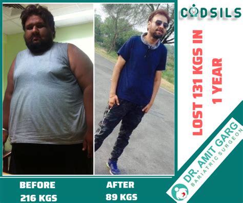 Bariatric Surgery Results Success Stories Dr Amit Garg