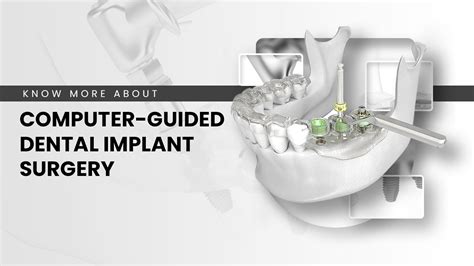 Computer Guided Dental Implant Surgery By Springvale Dental Clinic