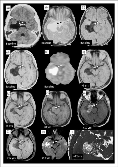 Dermoid Tumor Brain Mri