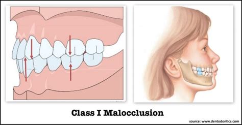 Malocclusion of Teeth- What is it? | K Smile Dental Care