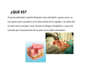 Quiste Pilonidal Ppt