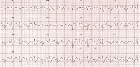 Killer Ecg Patterns • Litfl Medical Blog • Ecg Library