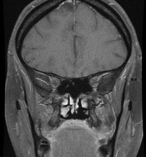 Idiopathic Intracranial Hypertension Iih Image