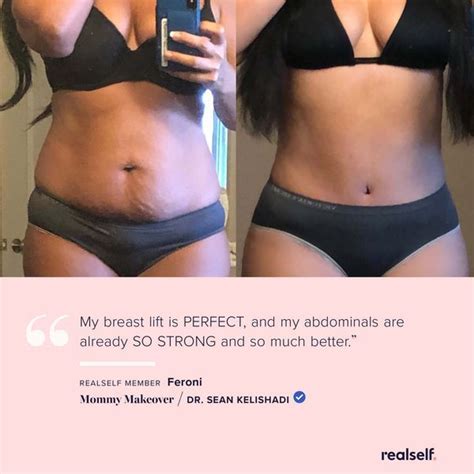 This Realself Member Shares Her Results After A Mommy Makeover Which