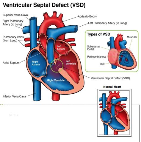 Post-delivery graphic anatomy: VSD - OB Images