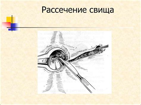 Свищ прямой кишки - online presentation