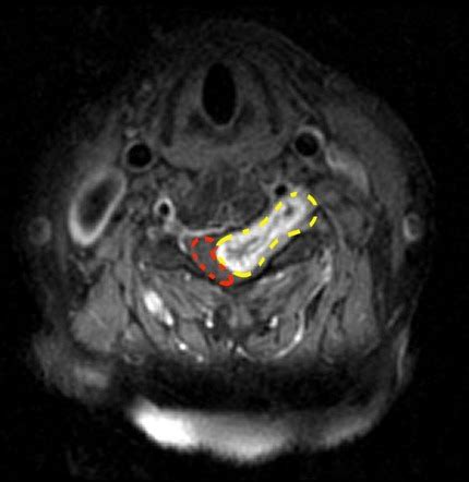 Spinal Schwannoma Cervical Image Radiopaedia Org