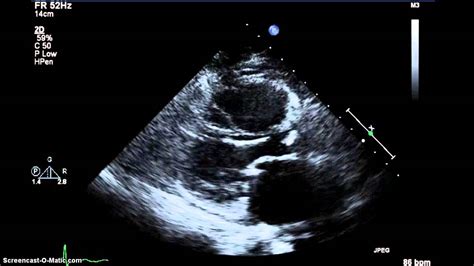 Rheumatic Mitral Valve Disease Acep American College Of Emergency