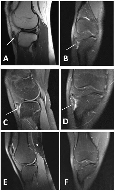 preoperative and postoperative magnetic resonance images (MrI) of the... | Download Scientific ...