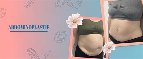 Abdominoplastie Tunisie Prix Et Conseils D Une Chirurgie Du Ventre