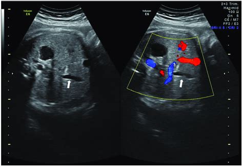 Image Of The Fetal Gallbladder White Arrow Noted Using 2d Ultrasound