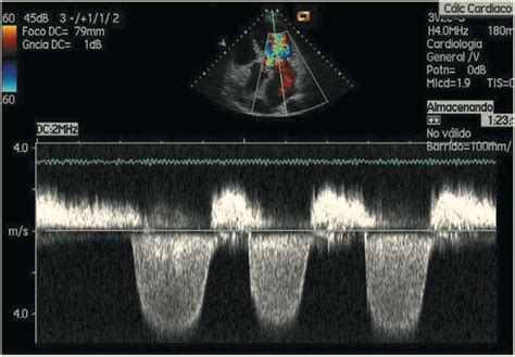 Doppler Pulsado Y Doppler Continuo