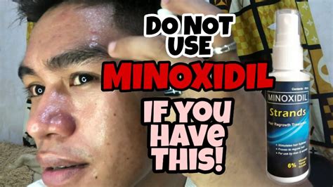 YOU MUST KNOW THIS IF YOU TRY TO USE MINOXIDIL FOR EYEBROW YouTube