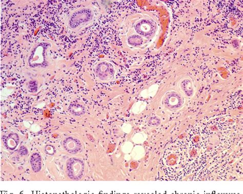 Chronic Sclerosing Sialadenitis Or Küttners Tumor Associated With A