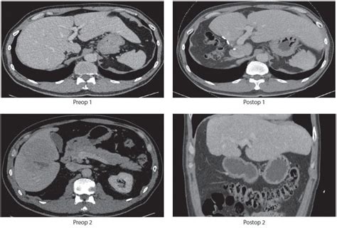 Liver Resection