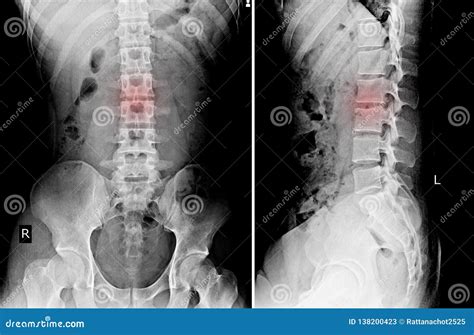 L S AP SpineLumbo SACRO Lateral Imagen De Archivo Imagen De Nervio
