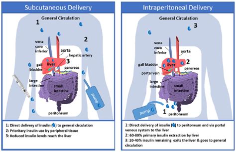 A New Optimized Percutaneous Access System For Cipii Rosa Garcia