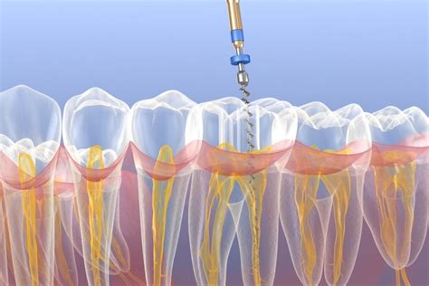 Endodontie Wurzelkanalbehandlung Zahnarztpraxis Dr Alexandra