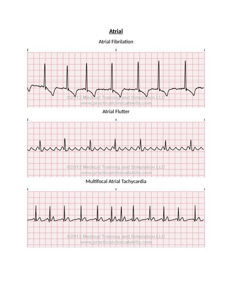 Solution Ekg Strips Docx Studypool