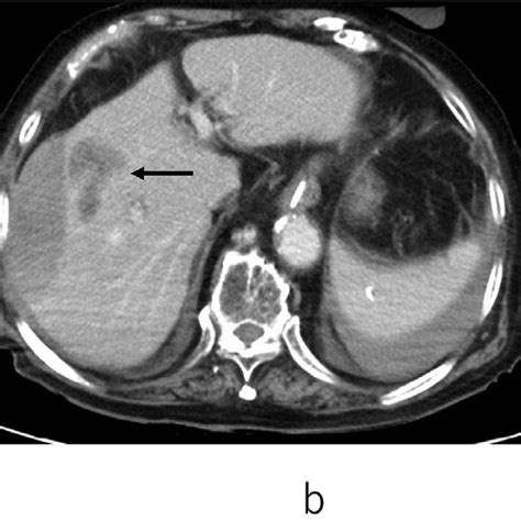 Contrast Enhanced Ct A Contrast Enhanced Ct Showed Intrahepatic Low