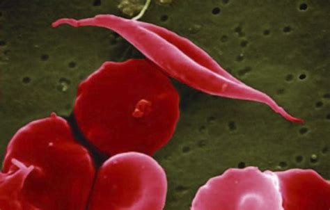 Us Approves Two Gene Therapies For Sickle Cell Disease Health News Et