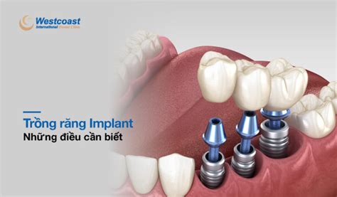 Trồng Răng Implant 4 Điều Bạn Cần Biết Nha khoa Quốc tế Westcoast