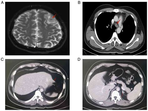 Synchronal Pulmonary Sarcomatoid Carcinoma And Lung Adenocarcinoma Eml4