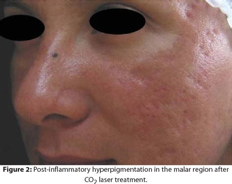 Figure 2 From Complications In Laser Dermatologic Surgery Part II