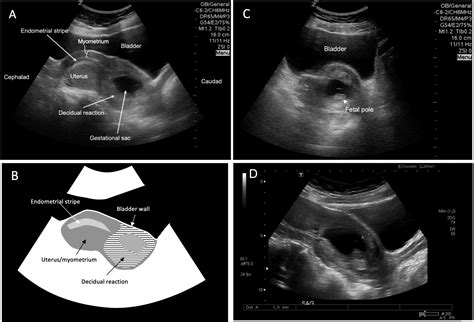 Cesarean Scar Ectopic Pregnancy Diagnosed By Point Of Care Ultrasound