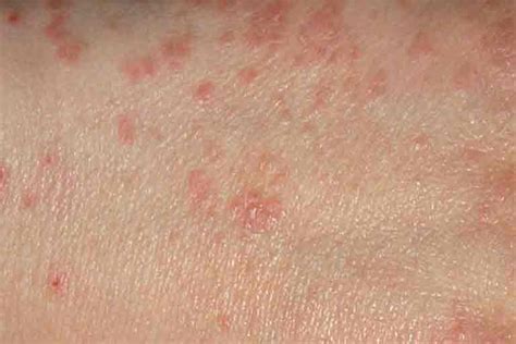 What Is Scabies Symptoms Causes Diagnosis Treatment 49 OFF