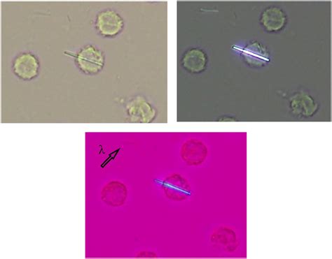 Identification Of Intracellular Vacuoles In Synovial Fluid 60 Off