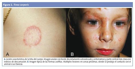 Dermatofitosis En Pediatria Pdf